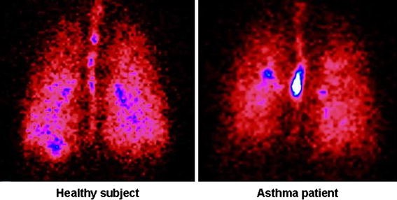 Foster®: A High-Efficiency Combination Metered Dose Inhaler with Consistent  Particle Size Distribution at Alternative Flow Rates | SpringerLink