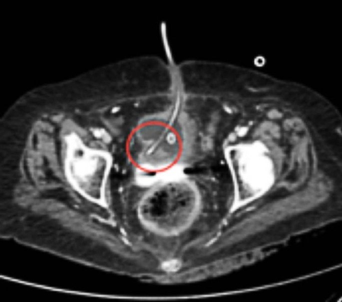 Case report. Een ongewone complicatie van suprapubische katheterisatie:  accidentele plaatsing van de katheter in de ureter | SpringerLink
