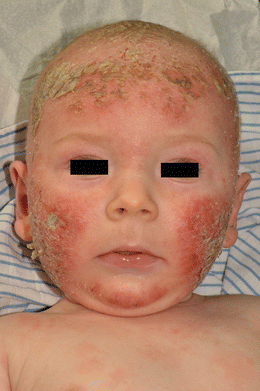 Atopic Dermatitis In Infants And Toddlers A Diagnostic Challenge In Daily Practice Springerlink