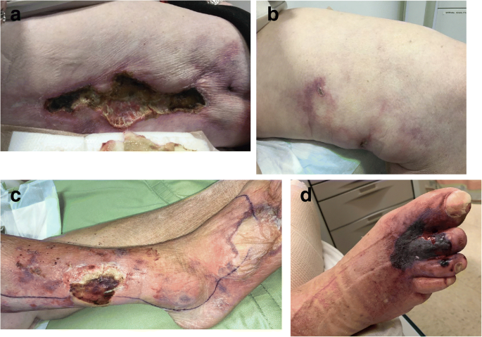 nonuremic calciphylaxis