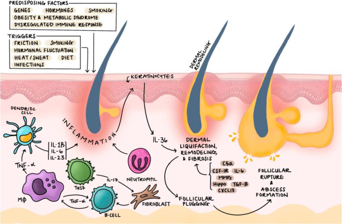 Update on Hidradenitis Suppurativa Management for the Inpatient ...