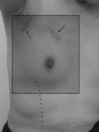 A case of Mondor's disease after whole breast radiotherapy and a review of  the literature | SpringerLink