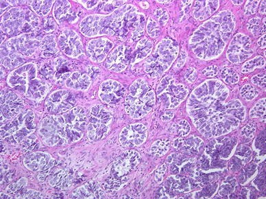 Basal Cell Carcinoma With Concomitant Insignificant Adenocarcinoma