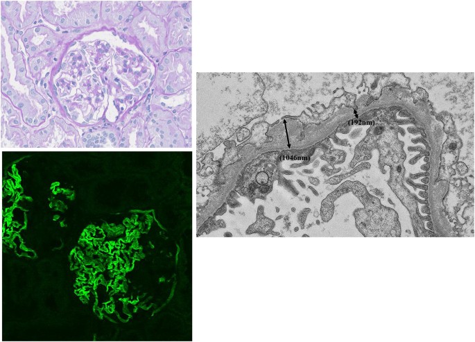 renal biopsy alport syndrome