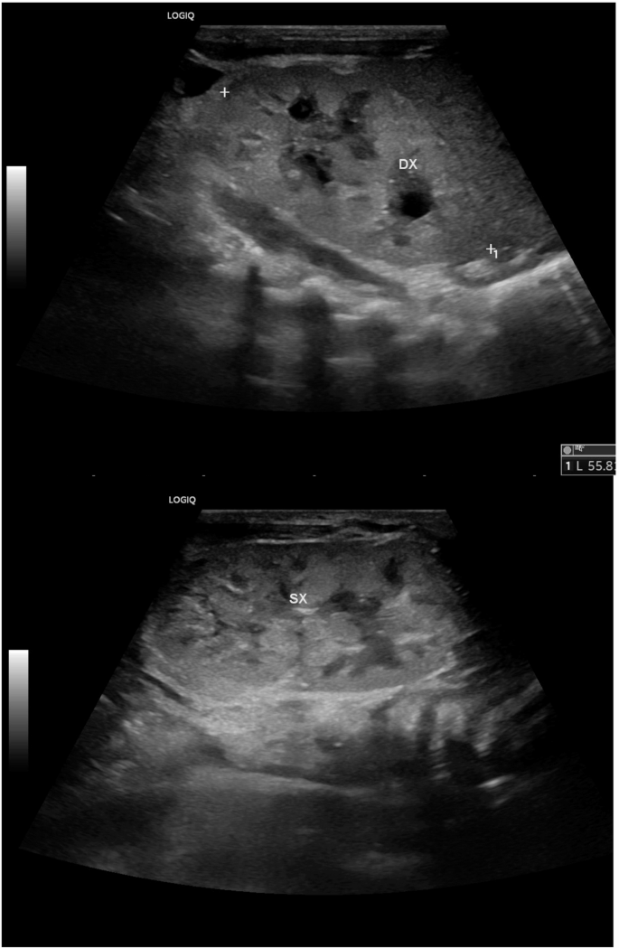 Congenital nephrotic syndrome in a newborn with glycogen storage ...