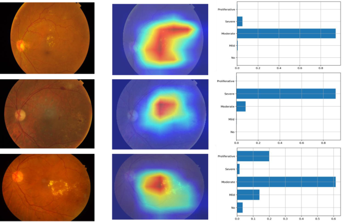 Correction: Self-supervised approach for diabetic retinopathy severity ...