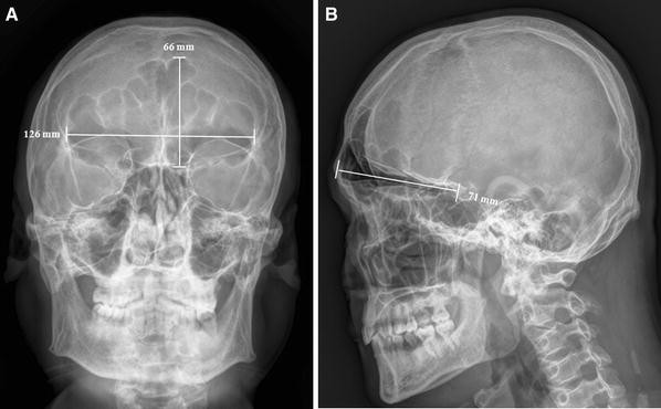 Extremely Large Frontal Sinus Pneumatocele An Unusual Variant Springerlink Extremely Large Frontal Sinus Pneumatocele An Unusual Variant Springerlink