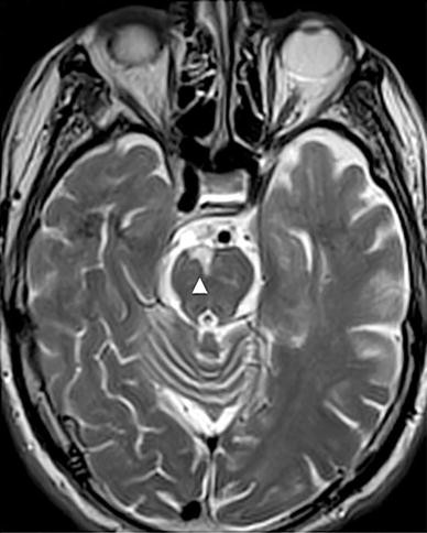 Wallerian Degeneration Of The Pontocerebellar Fibres Secondary To Pontine Infarction Springerlink