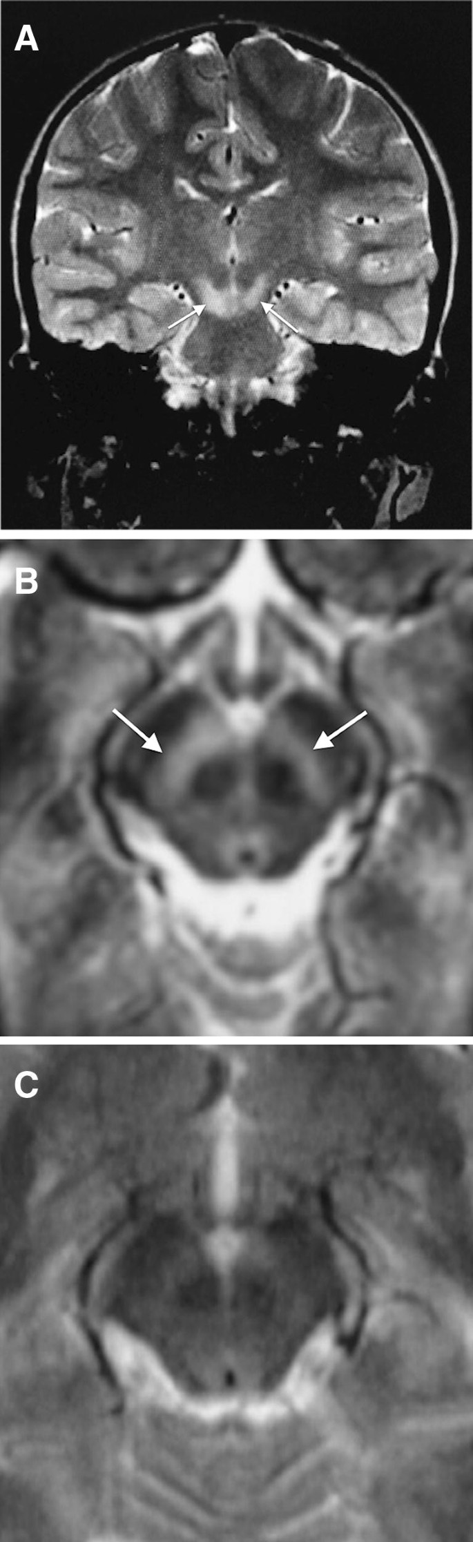 Isolated Substantia Nigra Lesions In Encephalitis A Specific Mri Pattern Springerlink