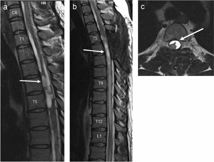 Spinal adhesive arachnoiditis: three case reports and review of literature  | SpringerLink