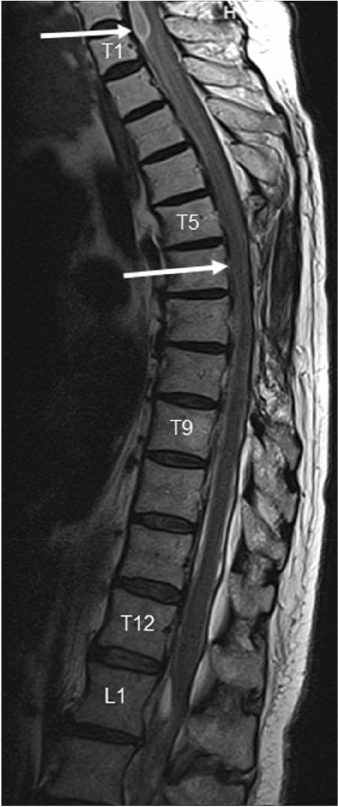 Spinal adhesive arachnoiditis: three case reports and review of literature  | Acta Neurologica Belgica