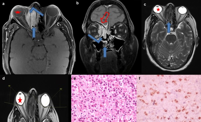 A new-found cause of “guitar pick sign”: IGG4 related disease | SpringerLink