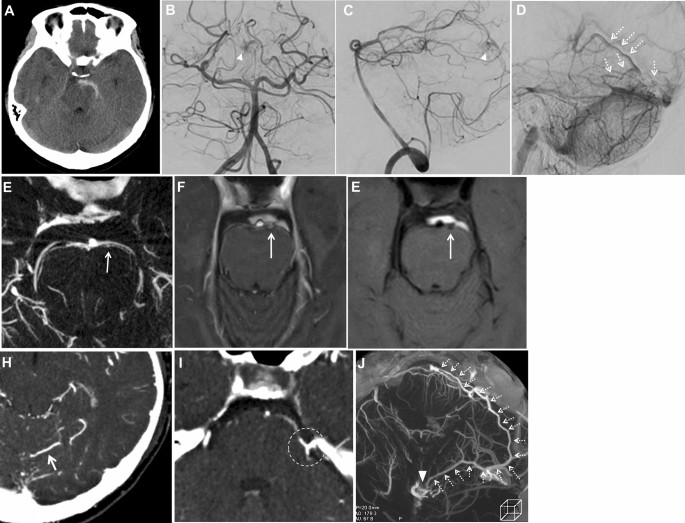 Peri-mesencephalic subarachnoid hemorrhage due to venous aneurysm  associated cerebellar arteriovenous malformation: a case report |  SpringerLink