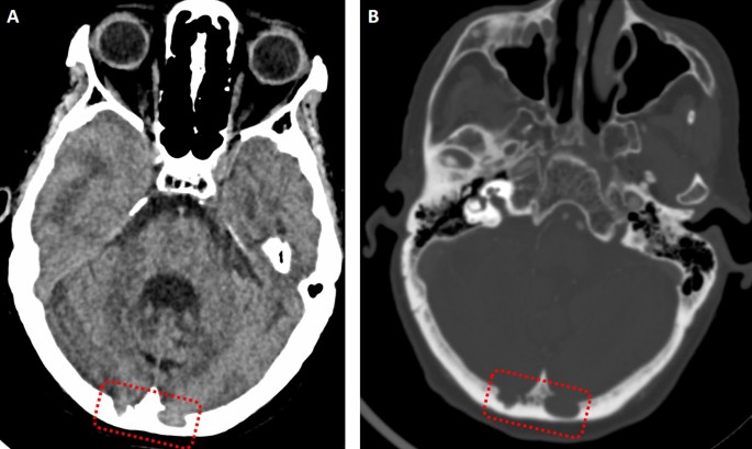 Abnormal Progression Of Brain Herniation Into Intraosseous Arachnoid 