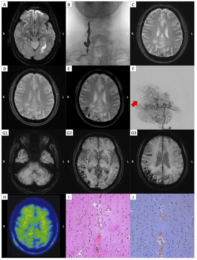 Rapid progression of cerebral amyloid angiopathy following coil ...