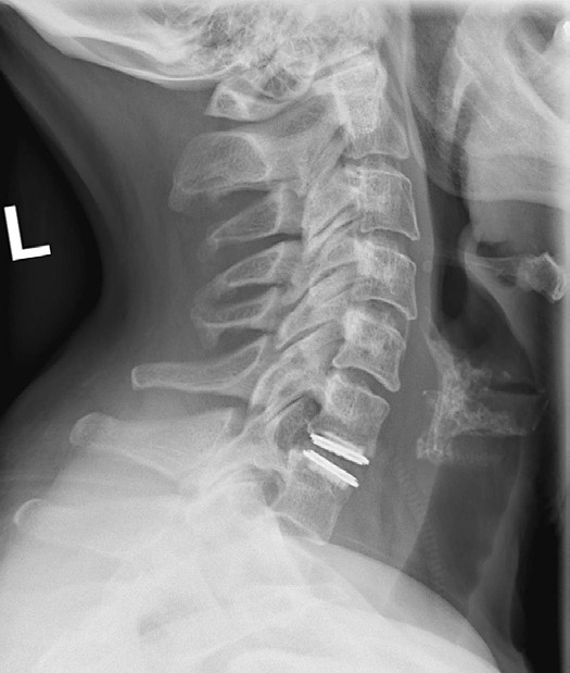 Lws behandlung der steilstellung Streckfehlhaltung im