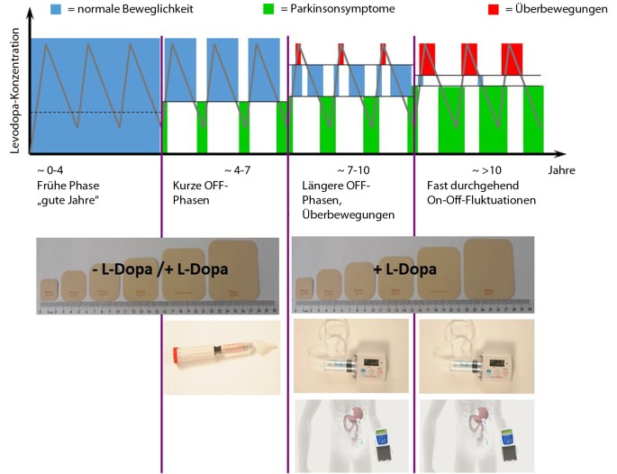 Wann sind Pflaster, Pens oder Pumpen eine sinnvolle Ergänzung zur oralen  Therapie? | SpringerLink