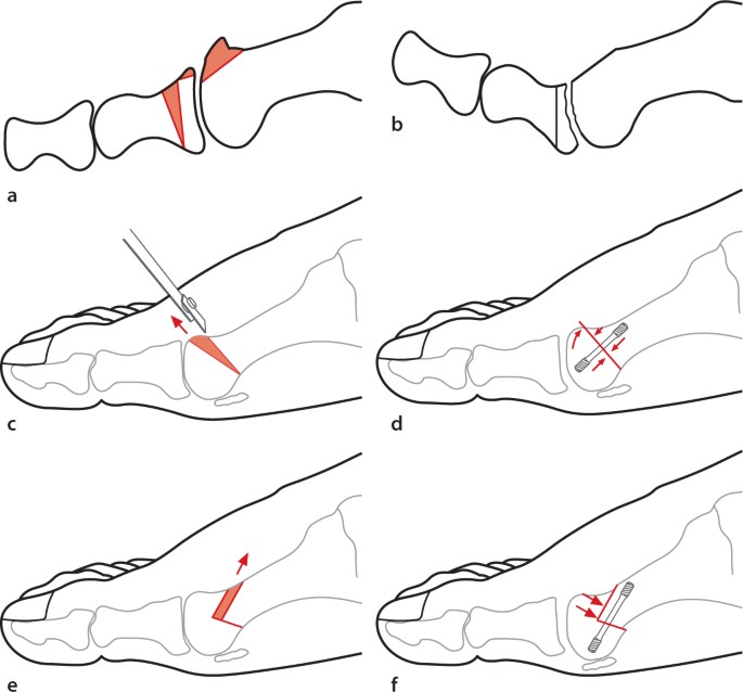 Тейпирование детей при вальгусе схема