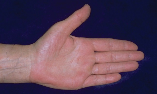 Ursache rote handinnenflächen Neurodermitis