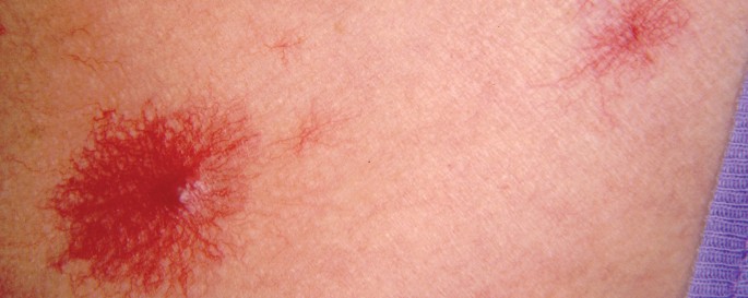 Aktuelle Therapieoptionen Bei Chronischer Hepatitis C Springerlink