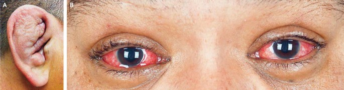 Schlimmes Ohr und rote Augen | SpringerLink