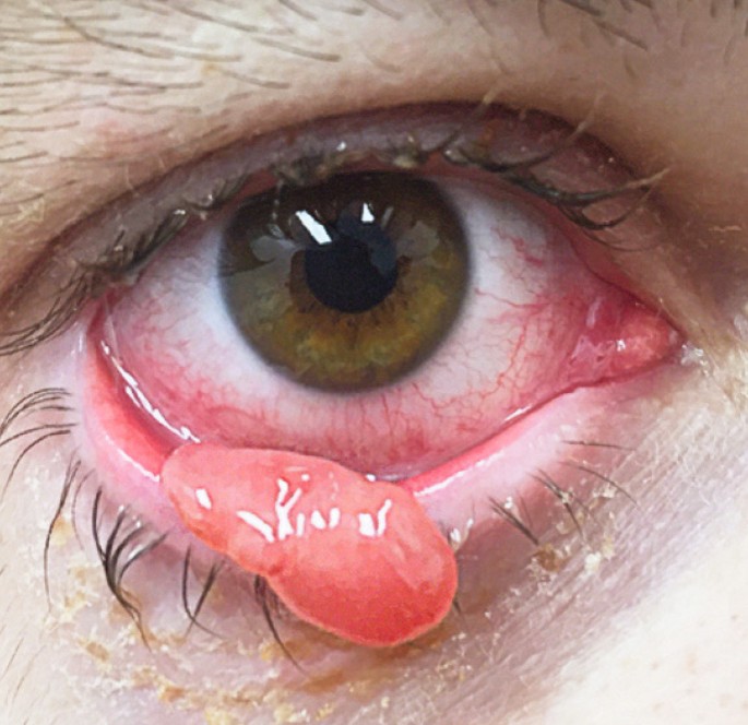 Binnen drei Tagen wächst ein Tumor aus dem Auge | SpringerLink