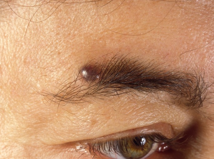 Steinharter Knoten an der Augenbraue | SpringerLink