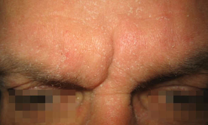 Er trägt ein HIV-Warnzeichen auf der Stirn | SpringerLink