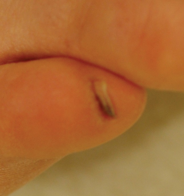 Der Nagel Meines Zeigefingers Verfarbt Sich Zunehmend Springerlink 