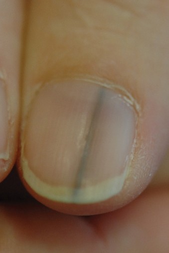 Der Nagel Meines Zeigefingers Verfarbt Sich Zunehmend Springerlink 