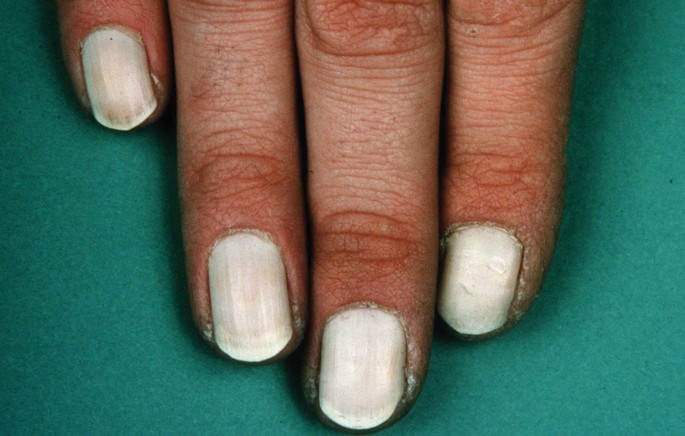 Rezepte Gegen Nagelpilz Springerlink 