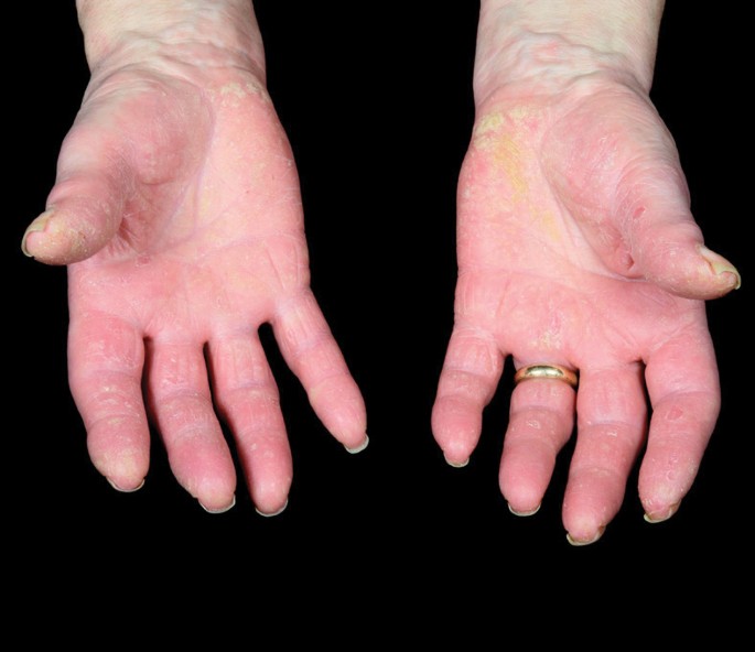Die Therapie Der Psoriasis Arthritis Auf Dem Neuesten Stand Springerlink Muster Fuer Naegel