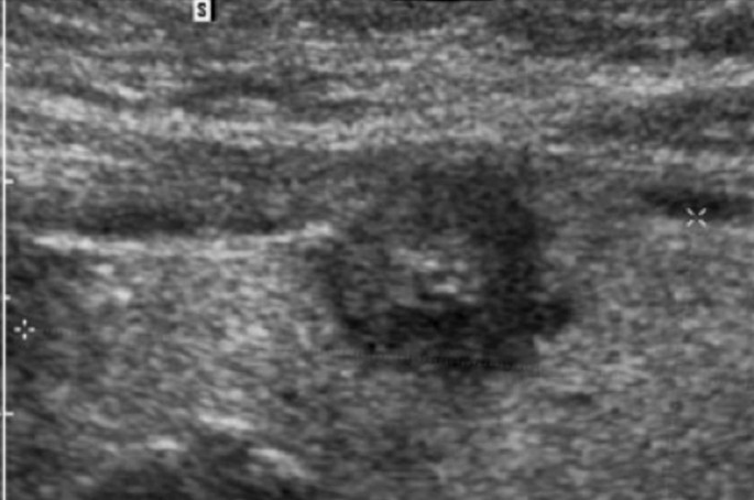 allgemeinarztliche sonografie teil 2 schilddruse thorax gefasse lymphknoten springerlink