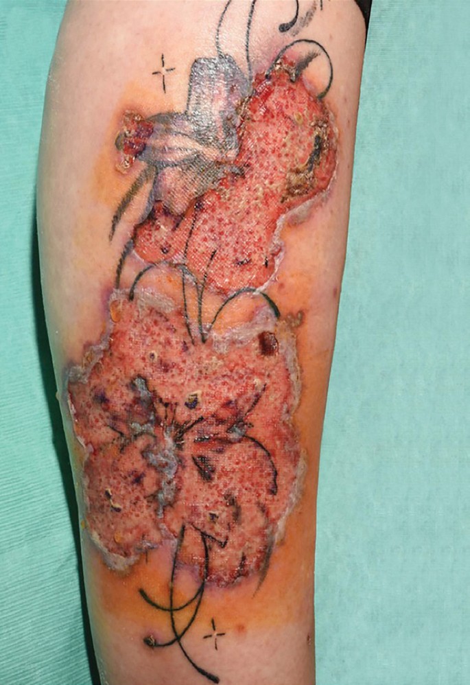 pusteln auf tattoo