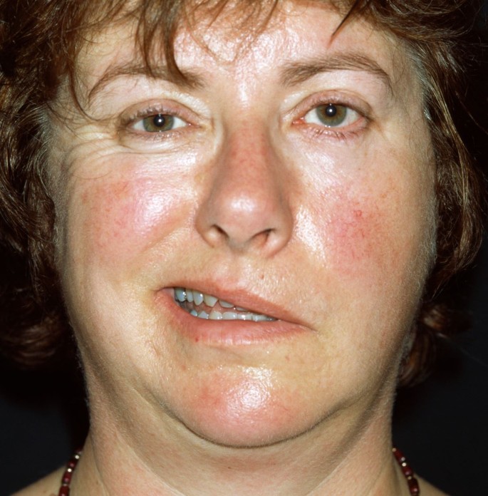 Die linke Gesichtshälfte hängt schief MMW Fortschritte der Medizin