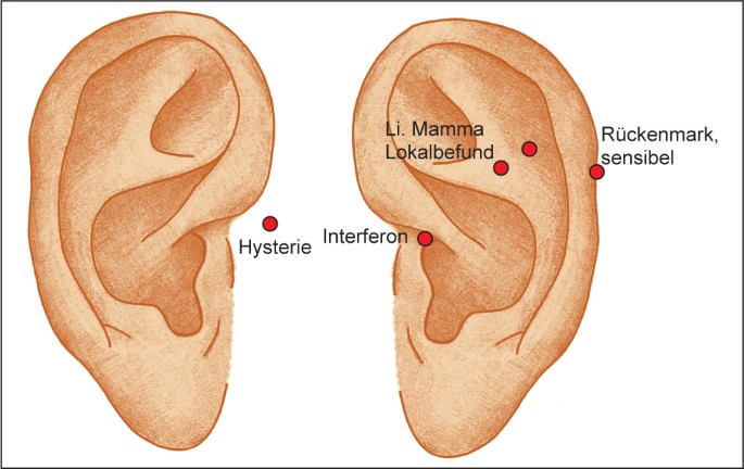 GÜRTELROSE DURCH PIERCING | SpringerLink