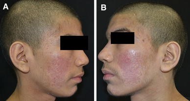 Citrobacter Koseri Folliculitis Of The Face Springerlink