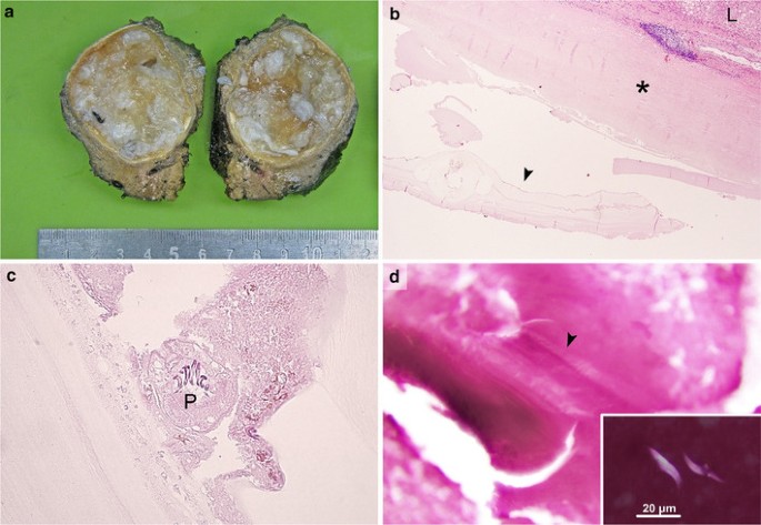 Schistosomiasis (Mételyféreg fertőzés)