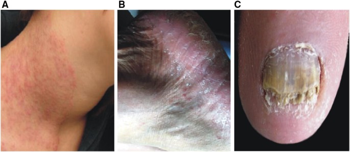 Unusual dermatomycoses caused by Nannizzia nana: the geophilic origin of  human infections | SpringerLink