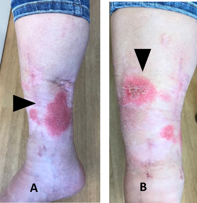 Fracture-Related Infection of the tibia due to a polymicrobial