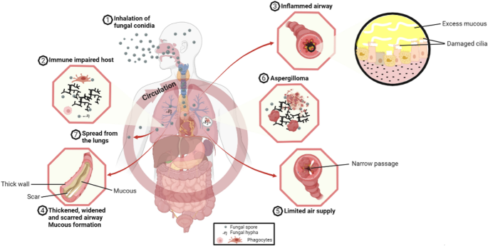 The clinical spectrum of aspergillosis in chronic obstructive