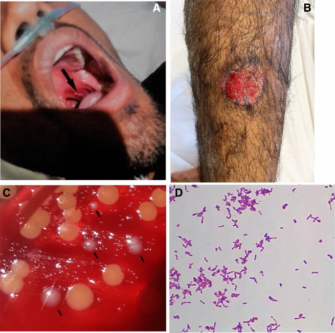 Pharyngeal and cutaneous diphtheria-Diphtheria-Causes-Symptoms-Diagnosis-Best treatment-Homeopathy-Dr-Qaisar-Ahmed