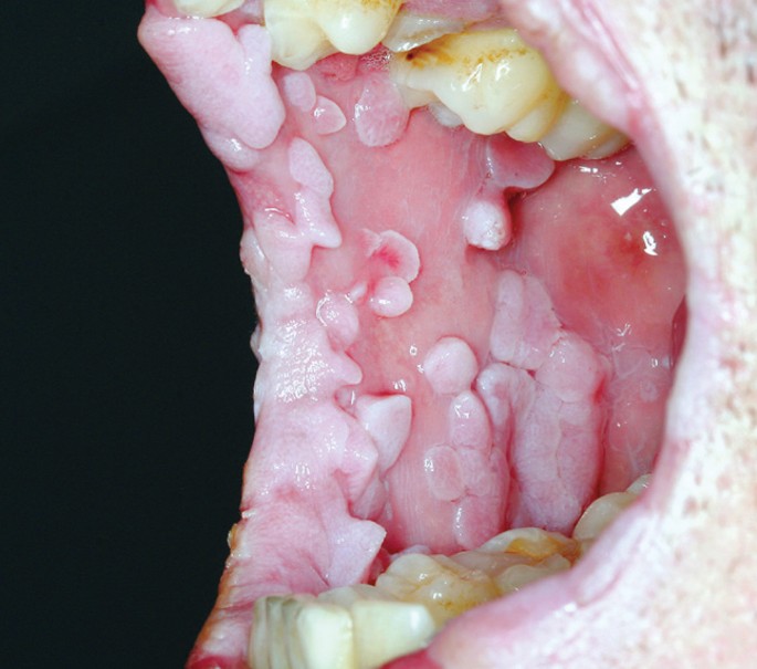 Hpv warzen intimbereich - Papilloma eltavolitasa lezerrel