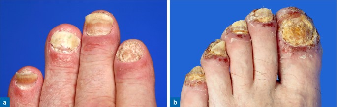 nagelpsoriasis eine therapeutische herausforderung springerlink