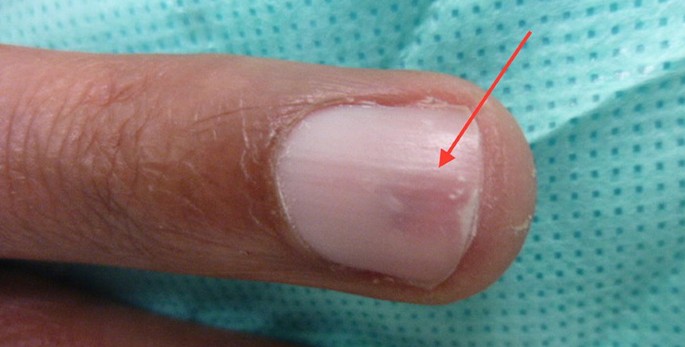 Ein Glomustumor unter dem Fingernagel | SpringerLink