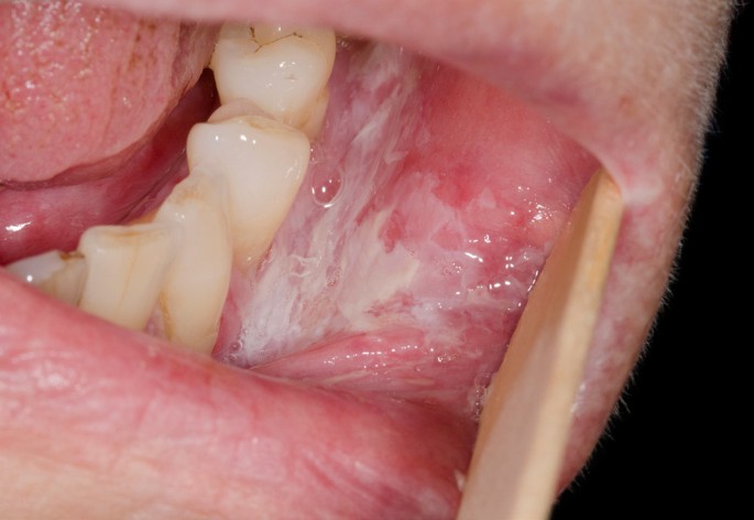 Krankheiten der oralen Mukosa | SpringerLink