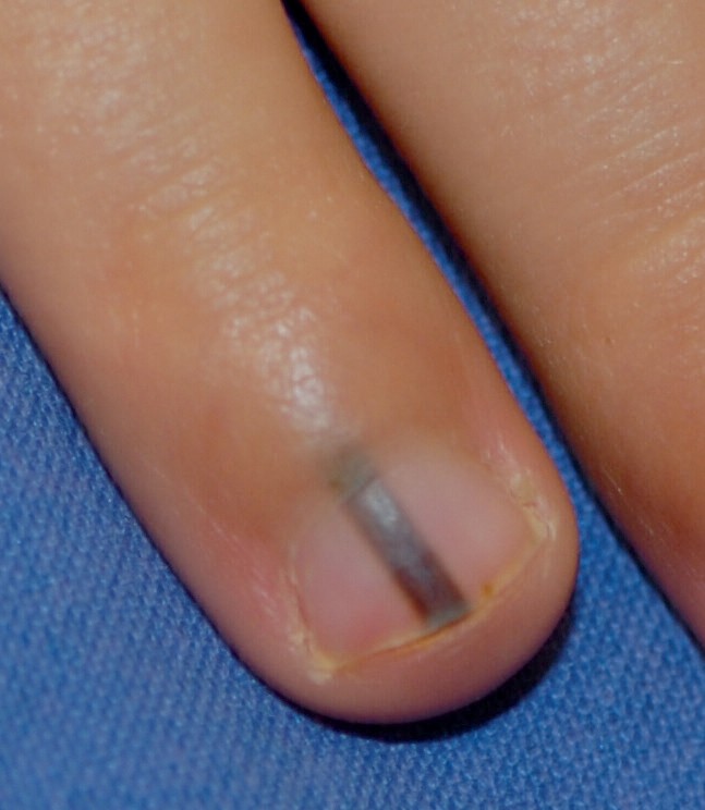 Was Tun Bei Nagelverfarbungen Springerlink 