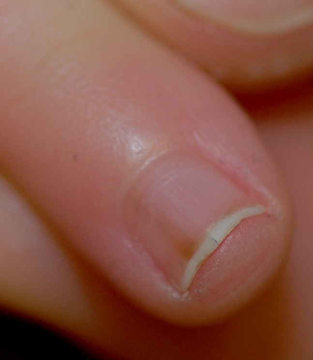 Was tun bei Nagelverfärbungen? | SpringerLink