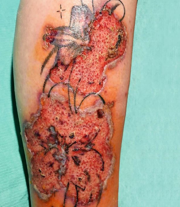 Ein Schones Tattoo Kann Auch Schmerzhaft Werden Springerlink