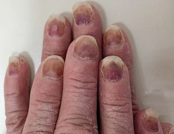 Gefärbte Fingernägel: Woher rührt die subunguale Blutung? | SpringerLink
